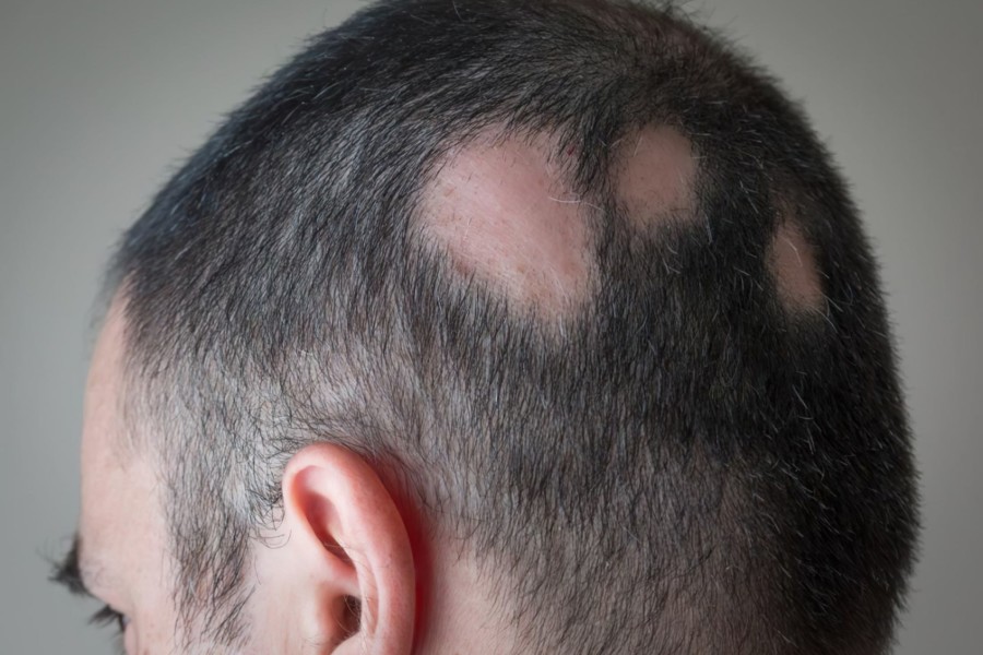 Een man met alopecia, met kale plekken op zijn hoofd.