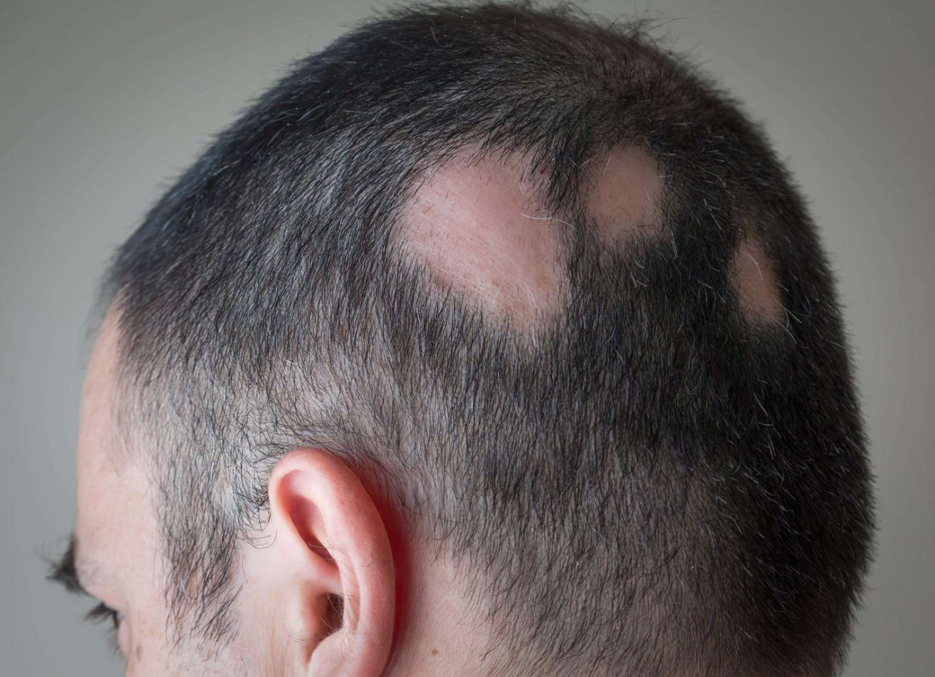 Een man met alopecia, met kale plekken op zijn hoofd.